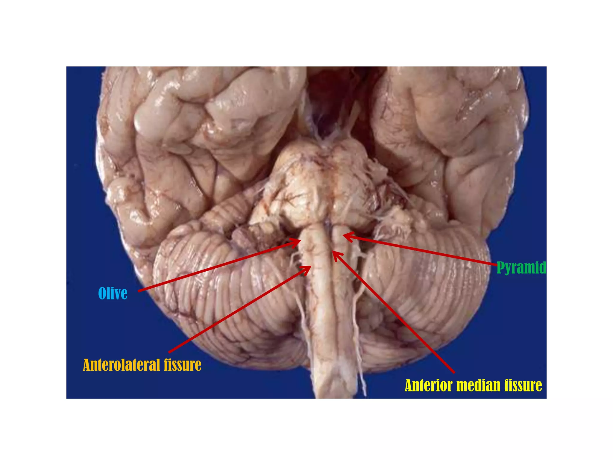 Pyramid
  Olive



Anterolateral fissure
                        Anterior median fissure
 