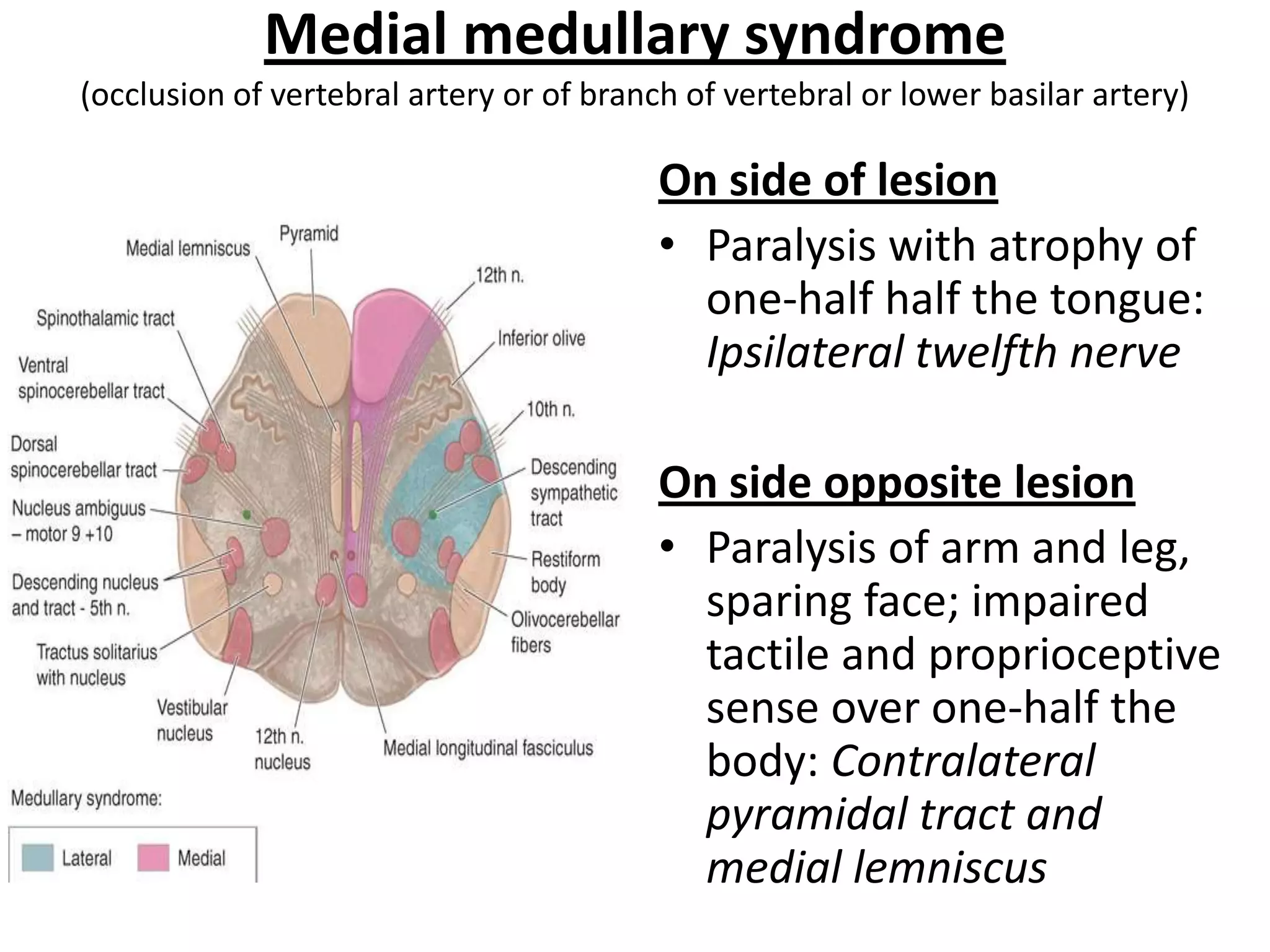 Medial medullary syndrome
(occlusion of vertebral artery or of branch of vertebral or lower basilar artery)

                                          On side of lesion
                                          • Paralysis with atrophy of
                                            one-half half the tongue:
                                            Ipsilateral twelfth nerve

                                          On side opposite lesion
                                          • Paralysis of arm and leg,
                                            sparing face; impaired
                                            tactile and proprioceptive
                                            sense over one-half the
                                            body: Contralateral
                                            pyramidal tract and
                                            medial lemniscus
 