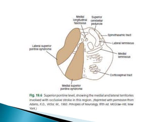 Brain stem syndromes | PPTX