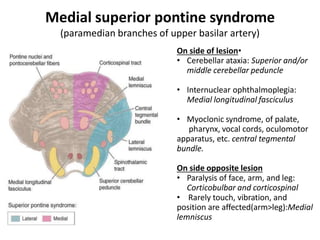 Medial superior pontine syndrome
(paramedian branches of upper basilar artery)
On side of lesion•
• Cerebellar ataxia: Superior and/or
middle cerebellar peduncle
• Internuclear ophthalmoplegia:
Medial longitudinal fasciculus
• Myoclonic syndrome, of palate,
pharynx, vocal cords, oculomotor
apparatus, etc. central tegmental
bundle.
On side opposite lesion
• Paralysis of face, arm, and leg:
Corticobulbar and corticospinal
• Rarely touch, vibration, and
position are affected(arm>leg):Medial
lemniscus
 