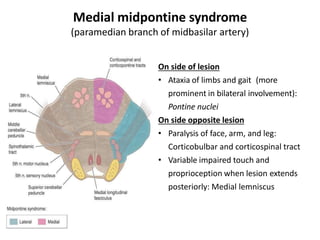 Medial midpontine syndrome
(paramedian branch of midbasilar artery)
On side of lesion
• Ataxia of limbs and gait (more
prominent in bilateral involvement):
Pontine nuclei
On side opposite lesion
• Paralysis of face, arm, and leg:
Corticobulbar and corticospinal tract
• Variable impaired touch and
proprioception when lesion extends
posteriorly: Medial lemniscus
 