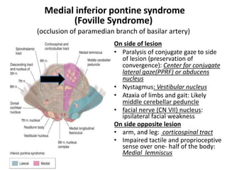 Medial inferior pontine syndrome
(Foville Syndrome)
(occlusion of paramedian branch of basilar artery)
On side of lesion
• Paralysis of conjugate gaze to side
of lesion (preservation of
convergence): Center for conjugate
lateral gaze(PPRF) or abducens
nucleus
• Nystagmus: Vestibular nucleus
• Ataxia of limbs and gait: Likely
middle cerebellar peduncle
• facial nerve (CN VII) nucleus:
ipsilateral facial weakness
On side opposite lesion
• arm, and leg: corticospinal tract
• Impaired tactile and proprioceptive
sense over one- half of the body:
Medial lemniscus
 