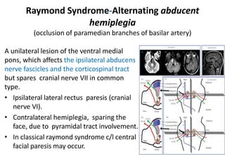 Raymond Syndrome-Alternating abducent
hemiplegia
(occlusion of paramedian branches of basilar artery)
A unilateral lesion of the ventral medial
pons, which affects the ipsilateral abducens
nerve fascicles and the corticospinal tract
but spares cranial nerve VII in common
type.
• Ipsilateral lateral rectus paresis (cranial
nerve VI).
• Contralateral hemiplegia, sparing the
face, due to pyramidal tract involvement.
• In classical raymond syndrome c/l central
facial paresis may occur.
 