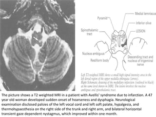 The picture shows a T2 weighted MRI in a patient with Avellis' syndrome due to infarction. A 47
year old woman developed sudden onset of hoarseness and dysphagia. Neurological
examination disclosed palsies of the left vocal cord and left soft palate, hypalgesia, and
thermohypaesthesia on the right side of the trunk and right arm, and bilateral horizontal
transient gaze dependent nystagmus, which improved within one month.
 