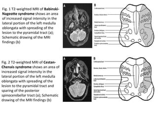 Fig. 1 T2-weighted MRI of Babinski-
Nageotte syndrome shows an area
of increased signal intensity in the
lateral portion of the left medulla
oblongata with spreading of the
lesion to the pyramidal tract (a);
Schematic drawing of the MRI
findings (b)
Fig. 2 T2-weighted MRI of Cestan-
Chenais syndrome shows an area of
increased signal intensity in the
lateral portion of the left medulla
oblongata with spreading of the
lesion to the pyramidal tract and
sparing of the posterior
spinocerebellar tract (a); Schematic
drawing of the MRI findings (b)
 