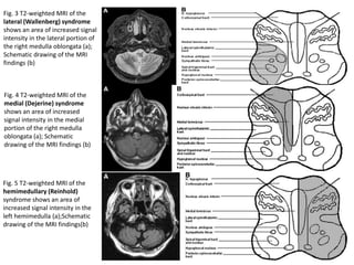 Fig. 5 T2-weighted MRI of the
hemimedullary (Reinhold)
syndrome shows an area of
increased signal intensity in the
left hemimedulla (a);Schematic
drawing of the MRI findings(b)
Fig. 4 T2-weighted MRI of the
medial (Dejerine) syndrome
shows an area of increased
signal intensity in the medial
portion of the right medulla
oblongata (a); Schematic
drawing of the MRI findings (b)
Fig. 3 T2-weighted MRI of the
lateral (Wallenberg) syndrome
shows an area of increased signal
intensity in the lateral portion of
the right medulla oblongata (a);
Schematic drawing of the MRI
findings (b)
 