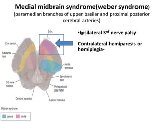 Medial midbrain syndrome(weber syndrome)
(paramedian branches of upper basilar and proximal posterior
cerebral arteries)
•Ipsilateral 3rd nerve palsy
Contralateral hemiparesis or
hemiplegia-
 