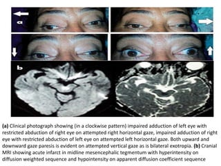 (a) Clinical photograph showing (in a clockwise pattern) impaired adduction of left eye with
restricted abduction of right eye on attempted right horizontal gaze, impaired adduction of right
eye with restricted abduction of left eye on attempted left horizontal gaze. Both upward and
downward gaze paresis is evident on attempted vertical gaze as is bilateral exotropia. (b) Cranial
MRI showing acute infarct in midline mesencephalic tegmentum with hyperintensity on
diffusion weighted sequence and hypointensity on apparent diffusion coefficient sequence
 