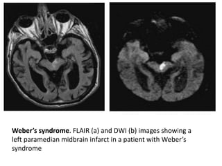 Weber’s syndrome. FLAIR (a) and DWI (b) images showing a
left paramedian midbrain infarct in a patient with Weber’s
syndrome
 