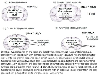 Effects of hyponatremia on the brain and adaptive mechanism. (a) Normonatremia: brain
osmolality is in equilibrium with extracellular fluid osmolality; (b) Acute hyponatremia: water
moves into the brain in response to an osmotic gradient, causing brain swelling; (c) Chronic
hyponatremia: within a few hours cells loss electrolytes (rapid adaption) and later on organic
osmolytes (slow adaption); the consequent loss of osmotically obligated water reduces cellular
swelling and normalizes brain volume (d) Osmotic demyelination: an overly rapid correction of
hyponatremia causes an inverse osmotic gradient with an excessive loss of water from the cells
causing brain dehydration and demyelination of white matter
 