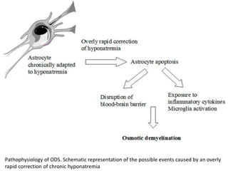 Pathophysiology of ODS. Schematic representation of the possible events caused by an overly
rapid correction of chronic hyponatremia
 