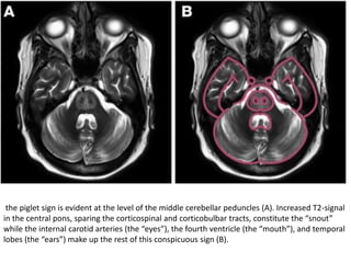 the piglet sign is evident at the level of the middle cerebellar peduncles (A). Increased T2-signal
in the central pons, sparing the corticospinal and corticobulbar tracts, constitute the “snout”
while the internal carotid arteries (the “eyes”), the fourth ventricle (the “mouth”), and temporal
lobes (the “ears”) make up the rest of this conspicuous sign (B).
 