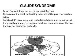 CLAUDE SYNDROME
• Result from midbrain dorsal tegmentum infarction.
• Occlusion of the small perforating branches of the posterior cerebral
artery
• Ipsilateral 3rd nerve palsy and contralateral ataxia and tremor result
from involvement of red nucleus, brachium conjunctivum or fibers of
the superior cerebellar peduncle.
 