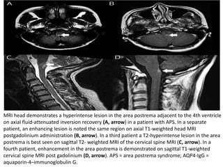 MRI head demonstrates a hyperintense lesion in the area postrema adjacent to the 4th ventricle
on axial fluid-attenuated inversion recovery (A, arrow) in a patient with APS. In a separate
patient, an enhancing lesion is noted the same region on axial T1-weighted head MRI
postgadolinium administration (B, arrow). In a third patient a T2-hyperintense lesion in the area
postrema is best seen on sagittal T2- weighted MRI of the cervical spine MRI (C, arrow). In a
fourth patient, enhancement in the area postrema is demonstrated on sagittal T1-weighted
cervical spine MRI post gadolinium (D, arrow). APS = area postrema syndrome; AQP4-IgG =
aquaporin-4–immunoglobulin G.
 