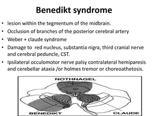 Benedikt syndrome
• lesion within the tegmentum of the midbrain.
• Occlusion of branches of the posterior cerebral artery
• Weber + claude syndrome
• Damage to red nucleus, substantia nigra, third cranial nerve
and cerebral peduncle, CST.
• Ipsilateral occulomotor nerve palsy contralateral hemiparesis
and cerebellar ataxia /or holmes tremor or choreoathetosis.
 
