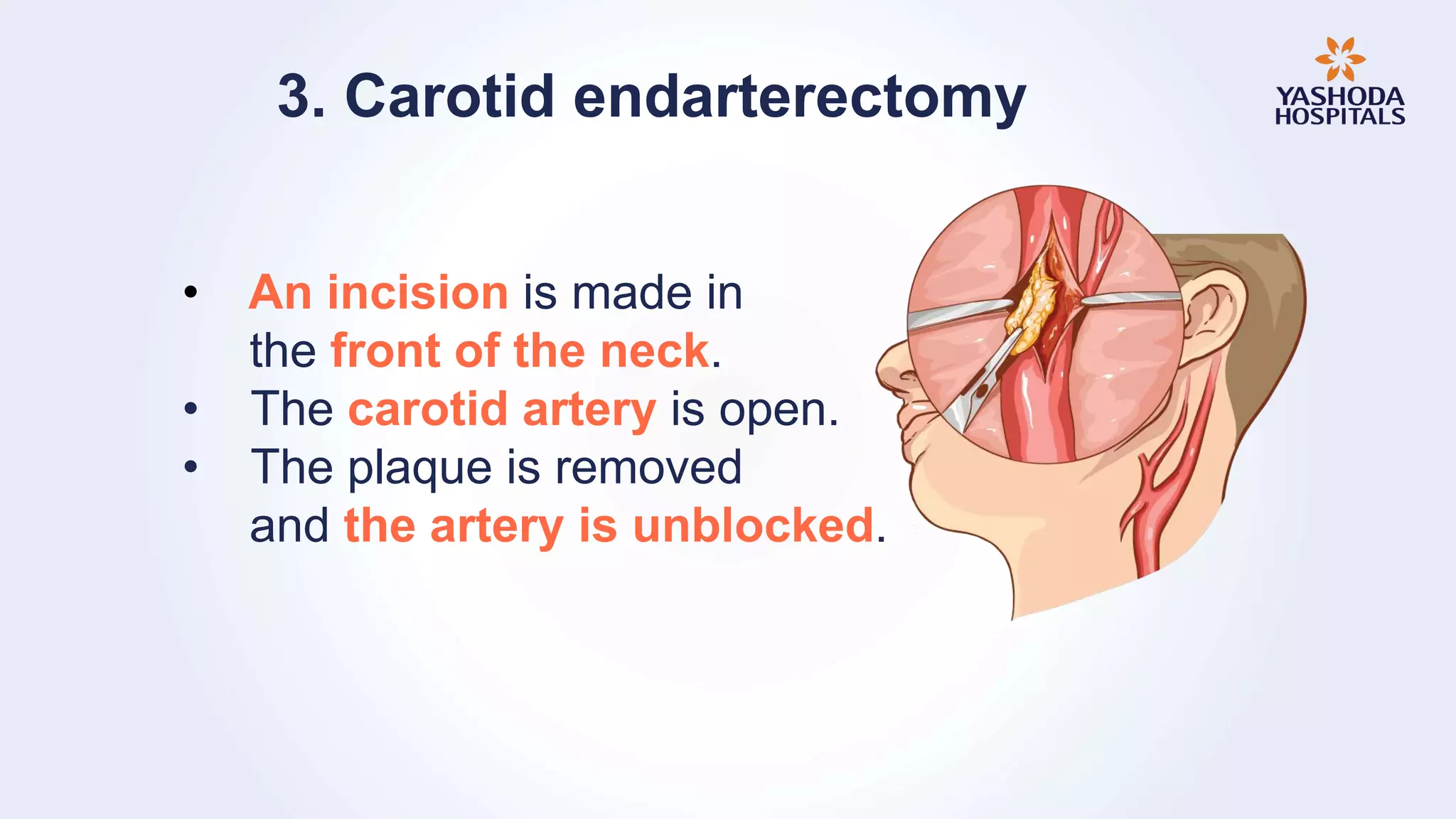 Brain stroke treatment | Yashoda Hospitals | PPTX