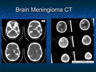 Brain Meningioma CTBrain Meningioma CT
 
