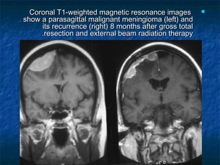 Coronal T1-weighted magnetic resonance imagesCoronal T1-weighted magnetic resonance images
show a parasagittal malignant meningioma (left) andshow a parasagittal malignant meningioma (left) and
its recurrence (right) 8 months after gross totalits recurrence (right) 8 months after gross total
resection and external beam radiation therapyresection and external beam radiation therapy..
 