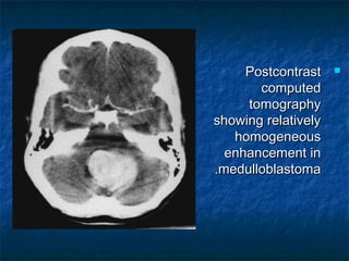PostcontrastPostcontrast
computedcomputed
tomographytomography
showing relativelyshowing relatively
homogeneoushomogeneous
enhancement inenhancement in
medulloblastomamedulloblastoma..
 