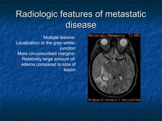 Radiologic features of metastaticRadiologic features of metastatic
diseasedisease
-Multiple lesions
-Localization at the grey-white
junction
-More circumscribed margins
-Relatively large amount of
edema compared to size of
lesion
 