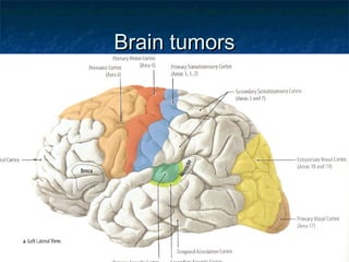 Brain tumorsBrain tumors
 