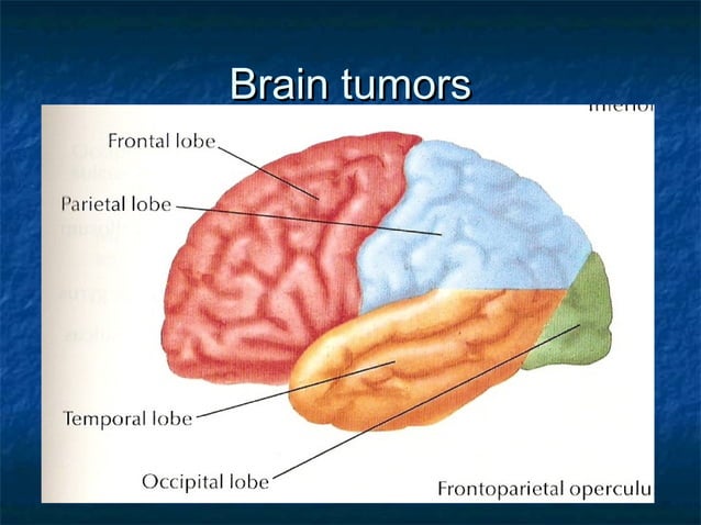 Brain tumor | PPT