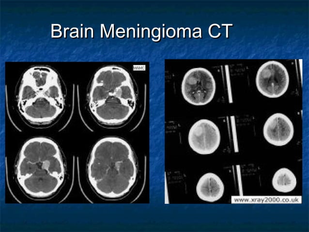 Brain Tumor PPT