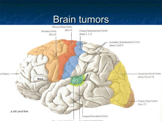 Brain Tumor PPT