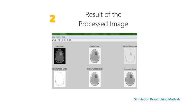 Brain Tumor Detection Using Image Processing | PPTX