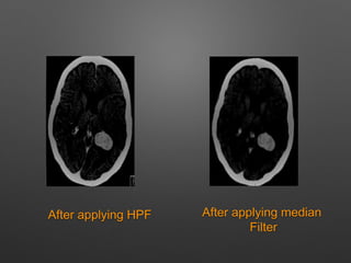 After applying HPF After applying median
Filter
 