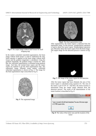 IJRET: International Journal of Research in Engineering and Technology eISSN: 2319-1163 | pISSN: 2321-7308
_______________________________________________________________________________________
Volume: 03 Issue: 03 | Mar-2014, Available @ http://www.ijret.org 371
Fig-4: The output image without skull tissues for skull
stripping step
In the marker controlled watershed segmentation, the brain
image without skull tissues is used to implement the step.
Sobel operator is applied on the brain image without skull
tissues and the gradient magnitude is calculated. Using the
gradient magnitude, the gradient image is found out. After
that, the watershed segmentation is estimated using gradient
image. And then, the normal brain region and the tumor
region are marked to get the final segmentation map. The
segmented image obtained using marker controlled
watershed segmentation is shown in Fig- 5. The image for
the final segmentation map is described in Fig.-6.
Fig- 5: The segmented image
Fig-6: The final segmentation map
After segmentation, the tumor region is detected from the
segmented image. In this process, morphological operation
is used to detect the tumor region. Morphological operation
can efficiently detect the tumor region from the brain image.
The output image for the detection process is shown in Fig-
7.
Fig.-7: The image of the tumor region for the detection
process
After the tumor region had been obtained, the area of the
tumor region is calculated using equation (5). The area of
the tumor is get 0.3191 in2
. And then, the tumor location is
determined using the output image obtained from the
detection process. The result of the determination of the
tumor location is described in Fig.-8.
Fig- 8: The value of the tumor area and the location of the
tumor
 