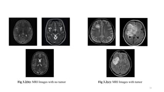 Advanced Brain Tumor Detection Using Deep Learning Models for MRI ...