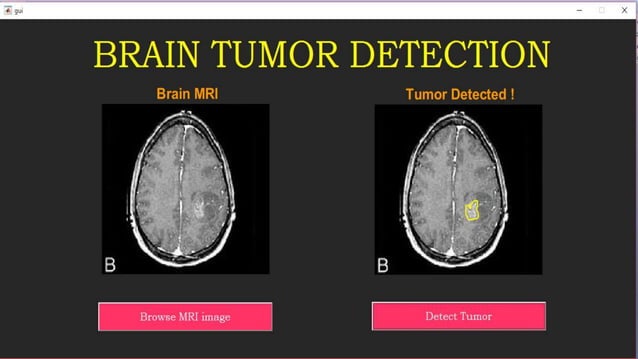 Brain tumor detection using image segmentation ppt | PPTX