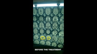 Brain Tumor, Left Cerebellar Tumor, SOL (Space occupying lesion ...