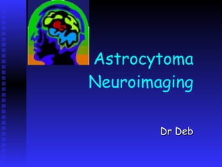Astrocytoma Neuroimaging  Dr Deb 