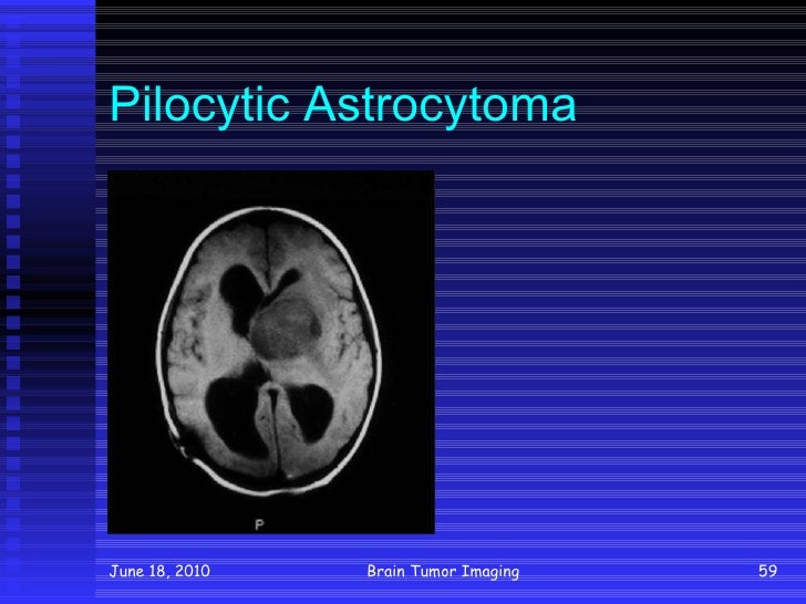 Was ist ein pilozytisches Astrozytom - Was sind die Symptome eines pilozytischen Astrozytoms