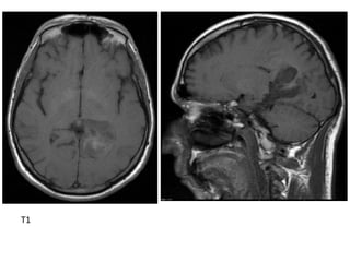 Diagnostic Imaging of Brain Tumors | PPT