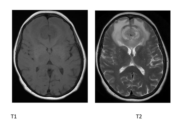Diagnostic Imaging of Brain Tumors | PPT