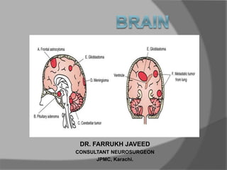 DR. FARRUKH JAVEED
CONSULTANT NEUROSURGEON
JPMC, Karachi.
 