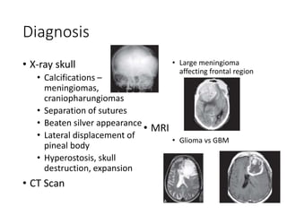Diagnosis
• X-ray skull
• Calcifications –
meningiomas,
craniopharungiomas
• Separation of sutures
• Beaten silver appearance
• Lateral displacement of
pineal body
• Hyperostosis, skull
destruction, expansion
• CT Scan
• Large meningioma
affecting frontal region
• MRI
• Glioma vs GBM
 