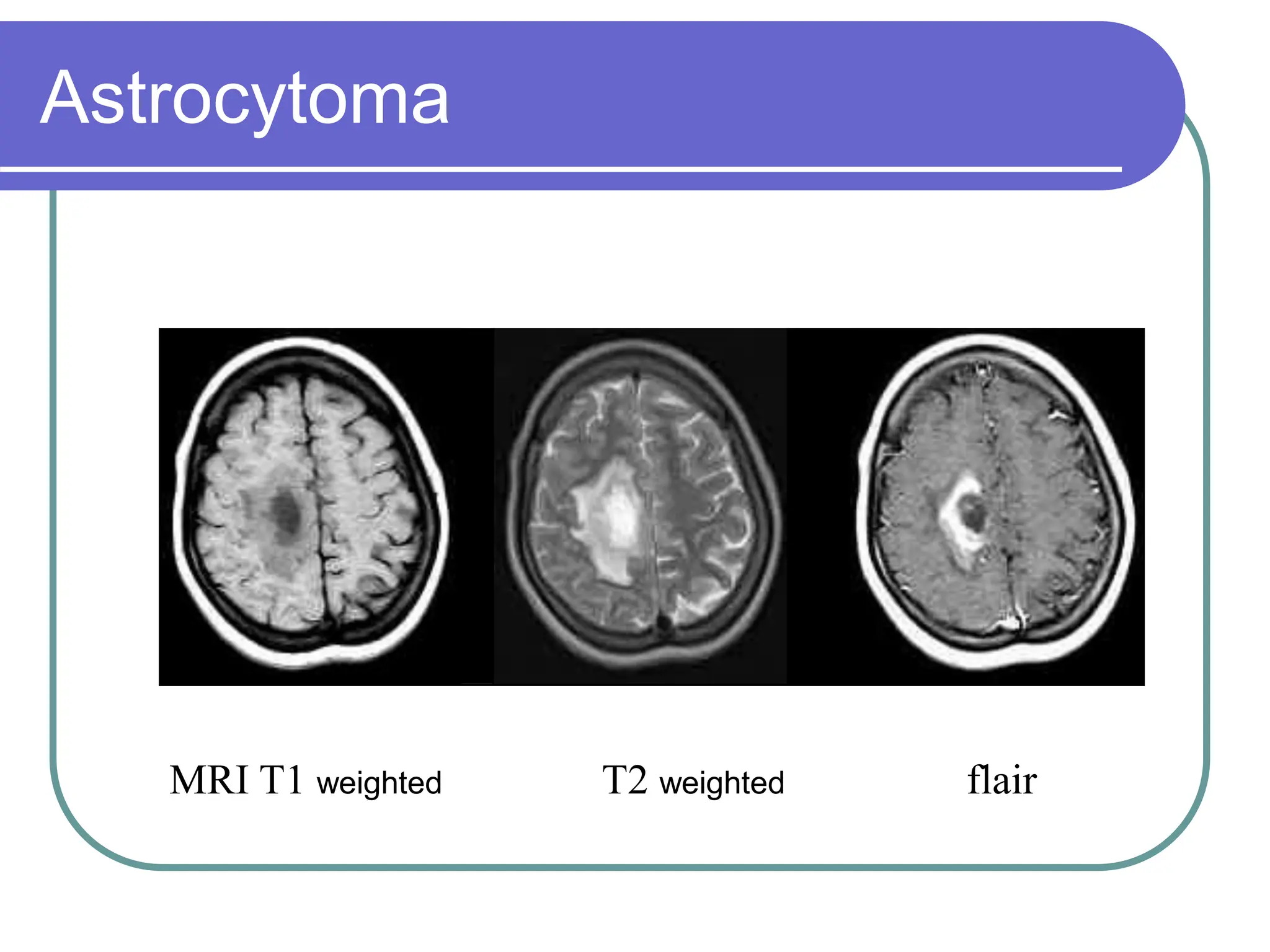 Brain Tumors Pathology and Management.ppt