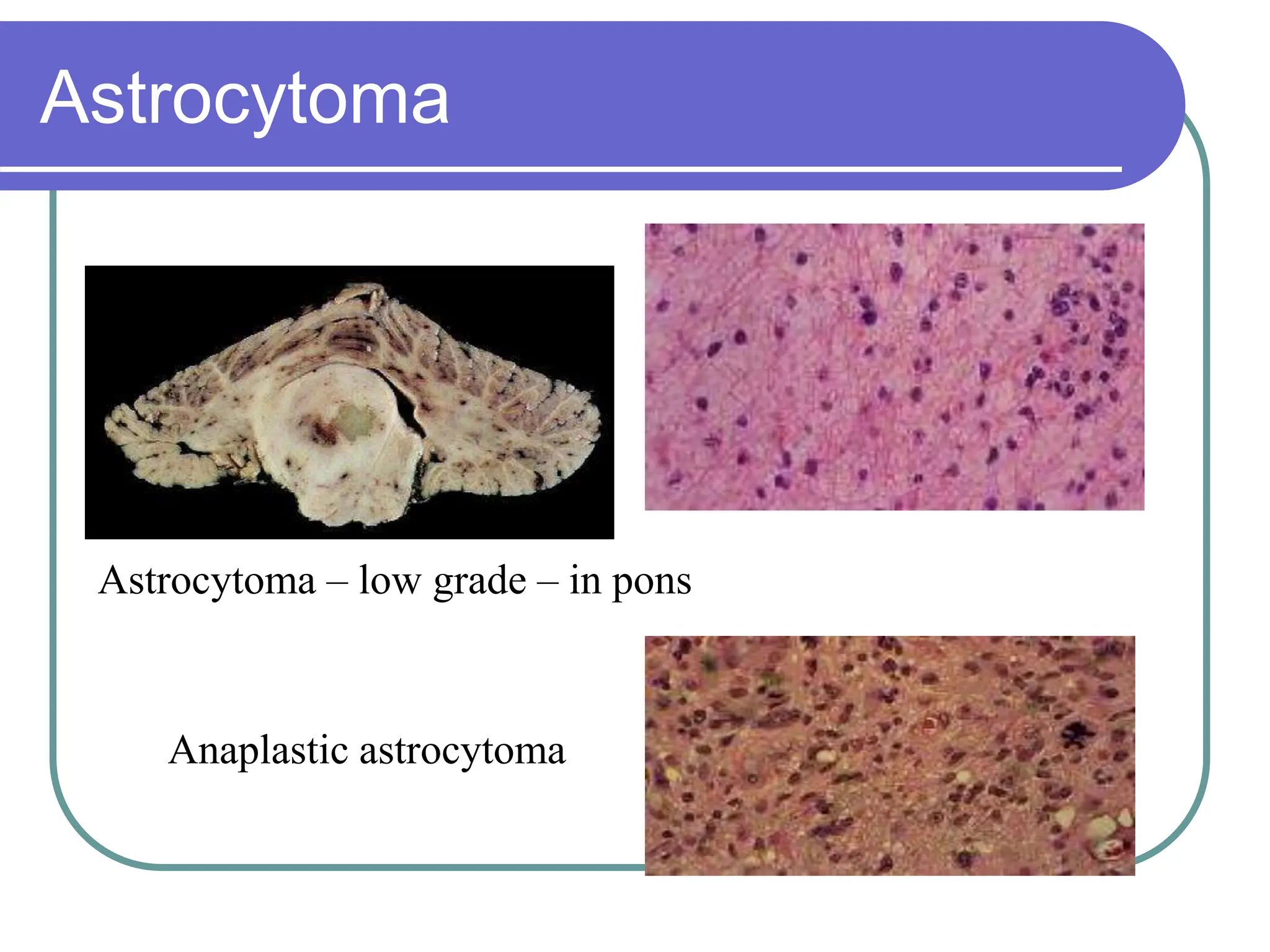 Brain Tumors Pathology and Management.ppt