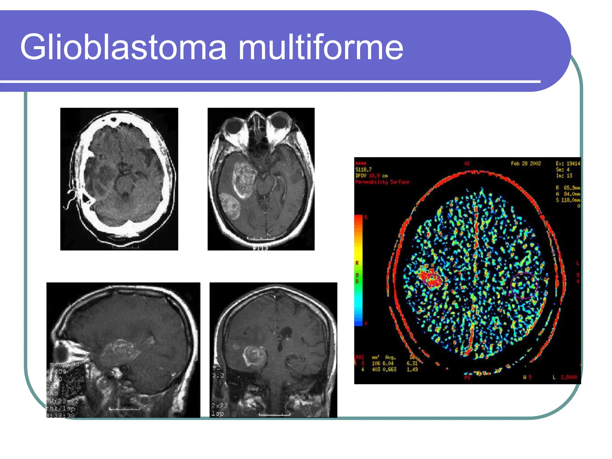 Brain Tumors Pathology and Management.ppt