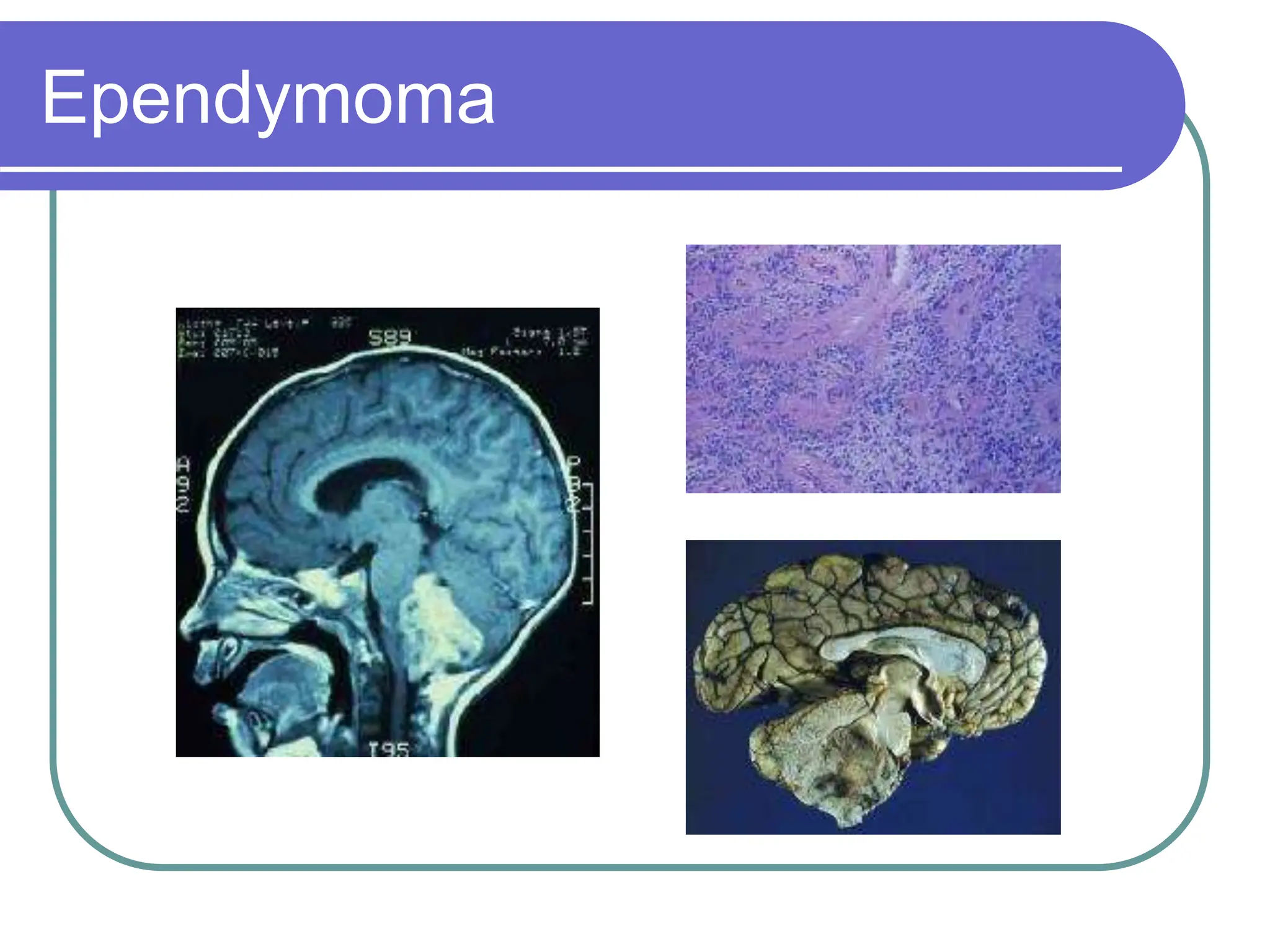 Brain Tumors Pathology and Management.ppt