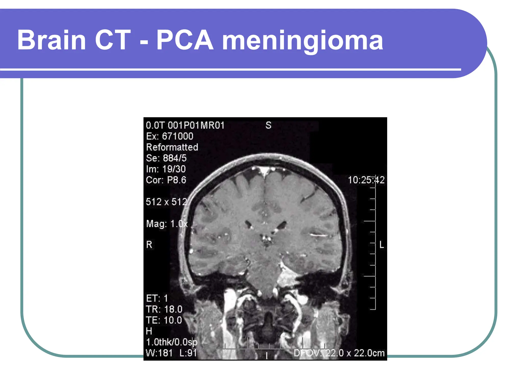 Brain Tumors Pathology and Management.ppt