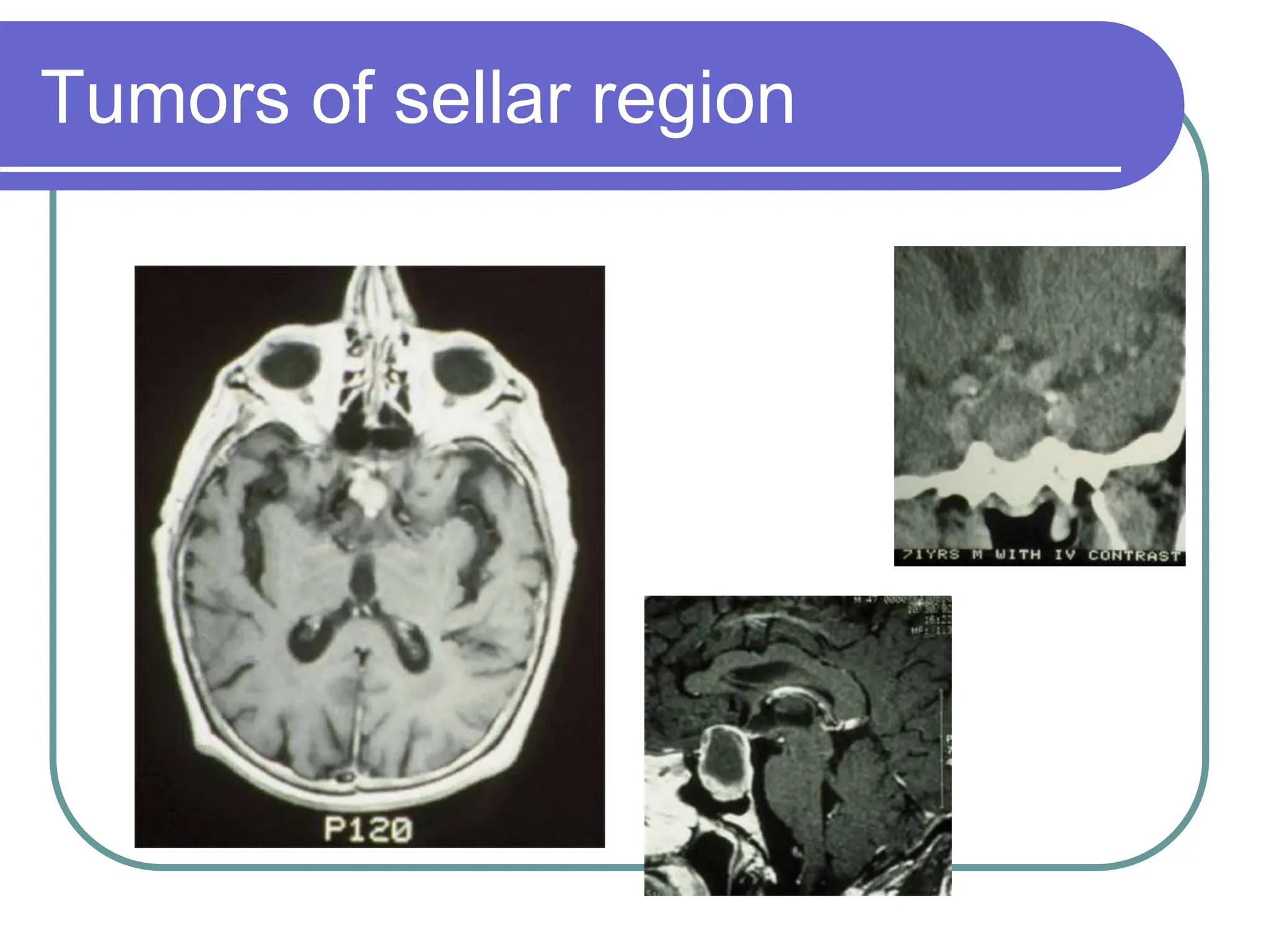 Brain Tumors Pathology and Management.ppt