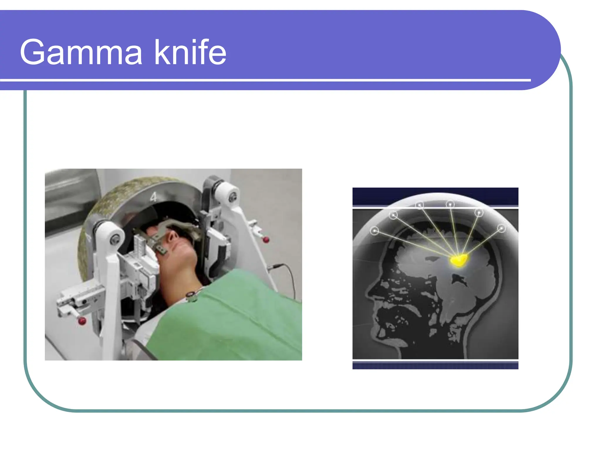 Brain Tumors Pathology and Management.ppt