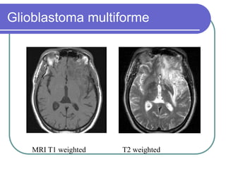 Brain Tumors Pathology and Management.ppt