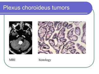 Brain Tumors Pathology and Management.ppt