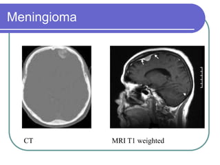 Brain Tumors Pathology and Management.ppt